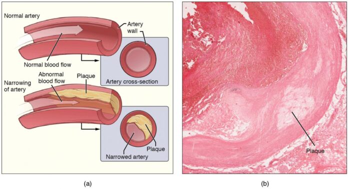 Clinical-trial-finds-RNA-inhibitor-effectively-reduces-bad-cholesterol-in.jpg