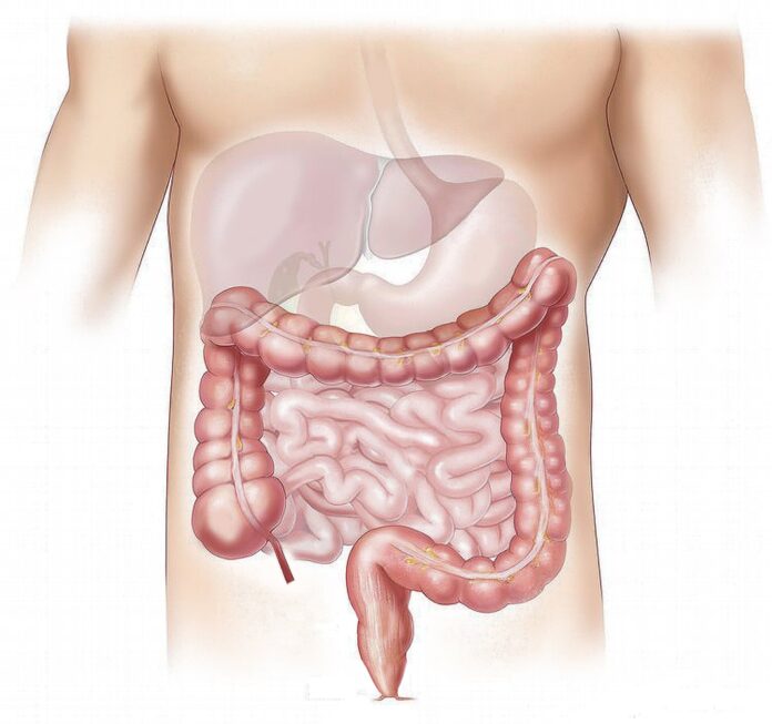 Healthy-lifestyle-linked-to-lower-diverticulitis-risk-irrespective-of-genetic.jpg
